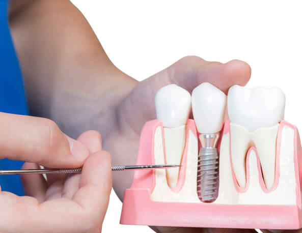 Dental-implants