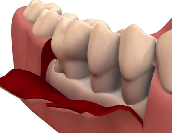 Flap-Surgery