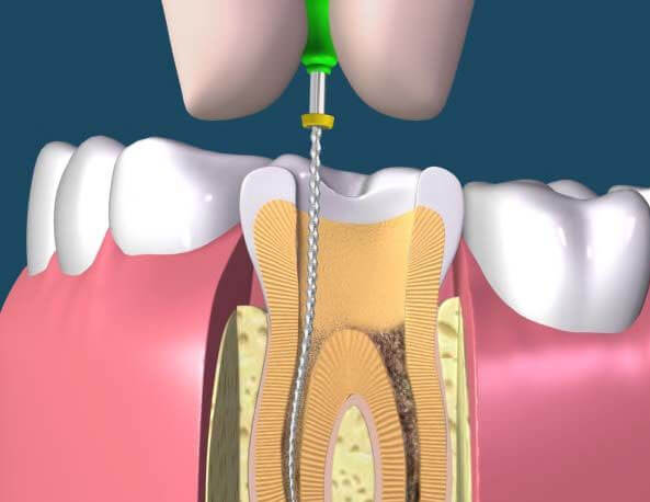 Pulpectomy-1