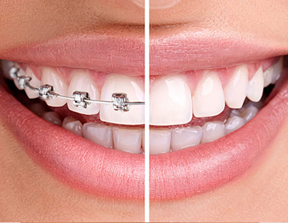 dental-braces