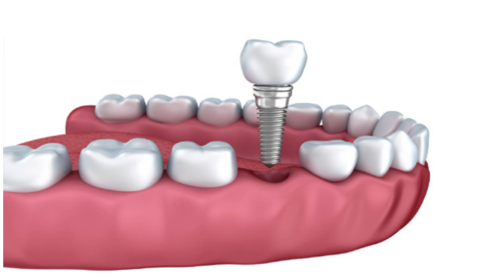 dental-crown-and-bridge-500×500