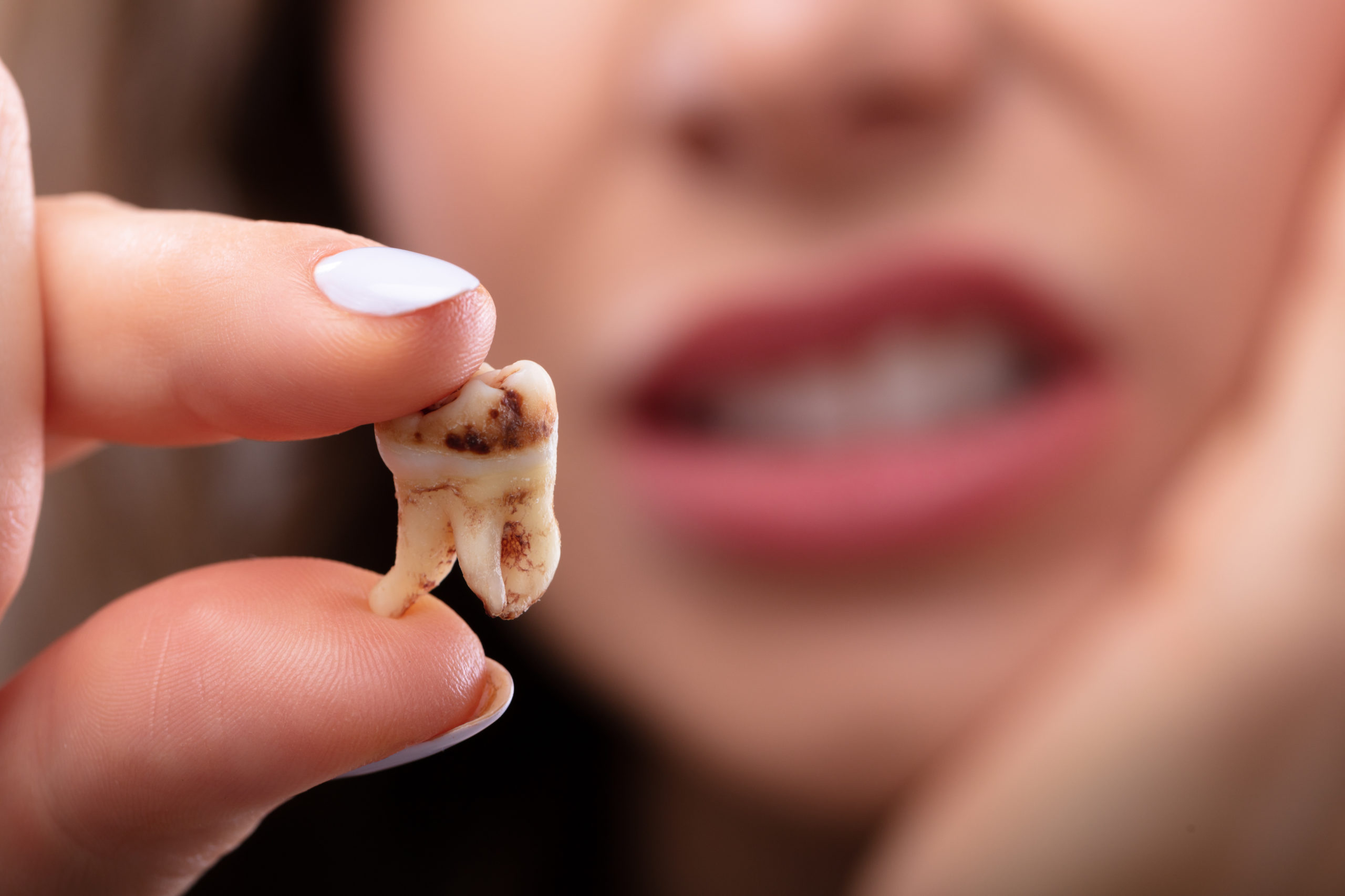 Woman Holding Decay Tooth