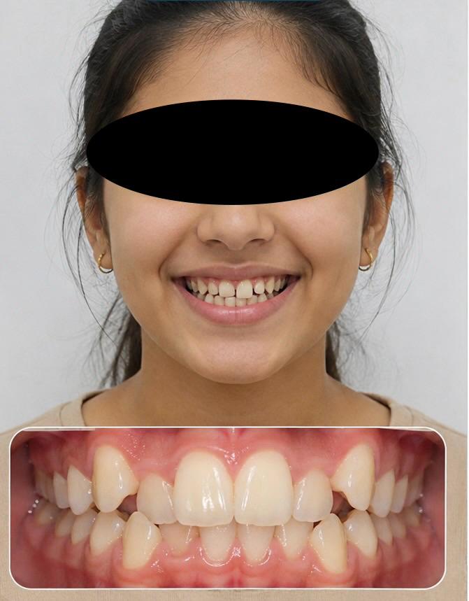 Before orthodontic treatment - misaligned teeth
