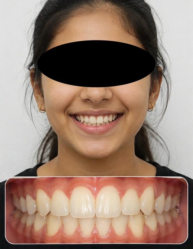 After orthodontic treatment - white aligned teeth perfect smile